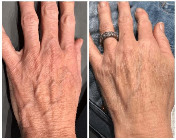 Fair Lawn Cool Peel - Lasting Impression Medical Spa