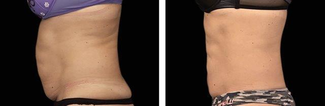 emsculpt fort lee nj