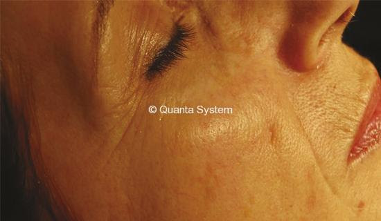 wrinkles evo light bergen county medical spa