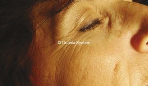 wrinkles evo light bergen county nj