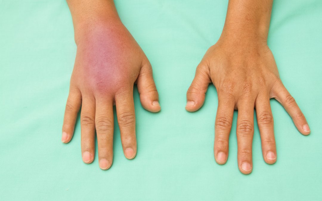reduce swelling after Coolsculpting