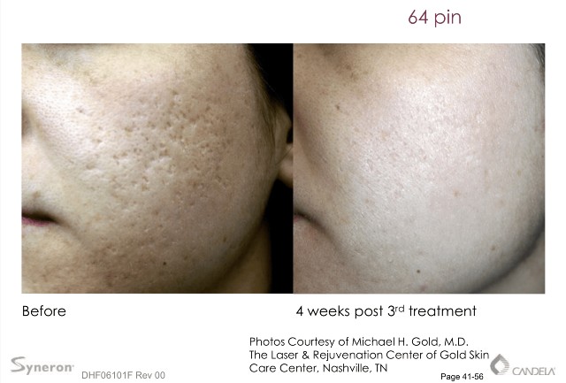 etwo sublative treatment in lasting impression in new jersey