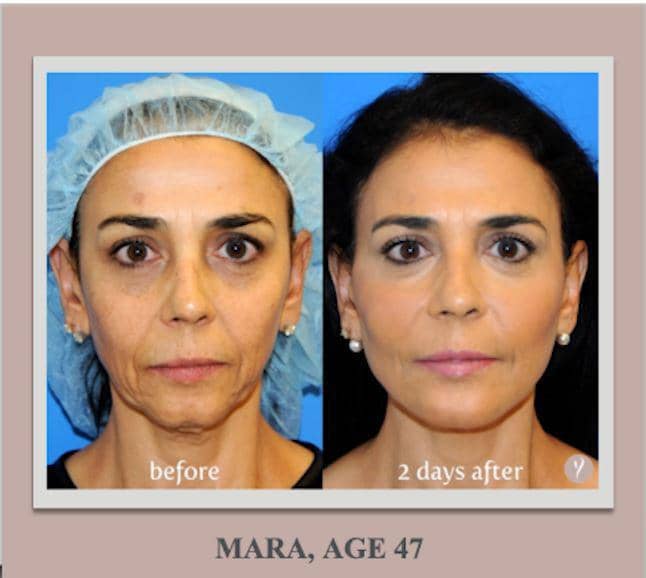 Y Lift Before and after | Medical Spa | Bergen County