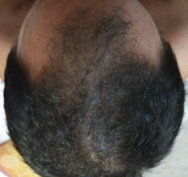 Hair Loss Treatment | Lasting Impression Medical Spa