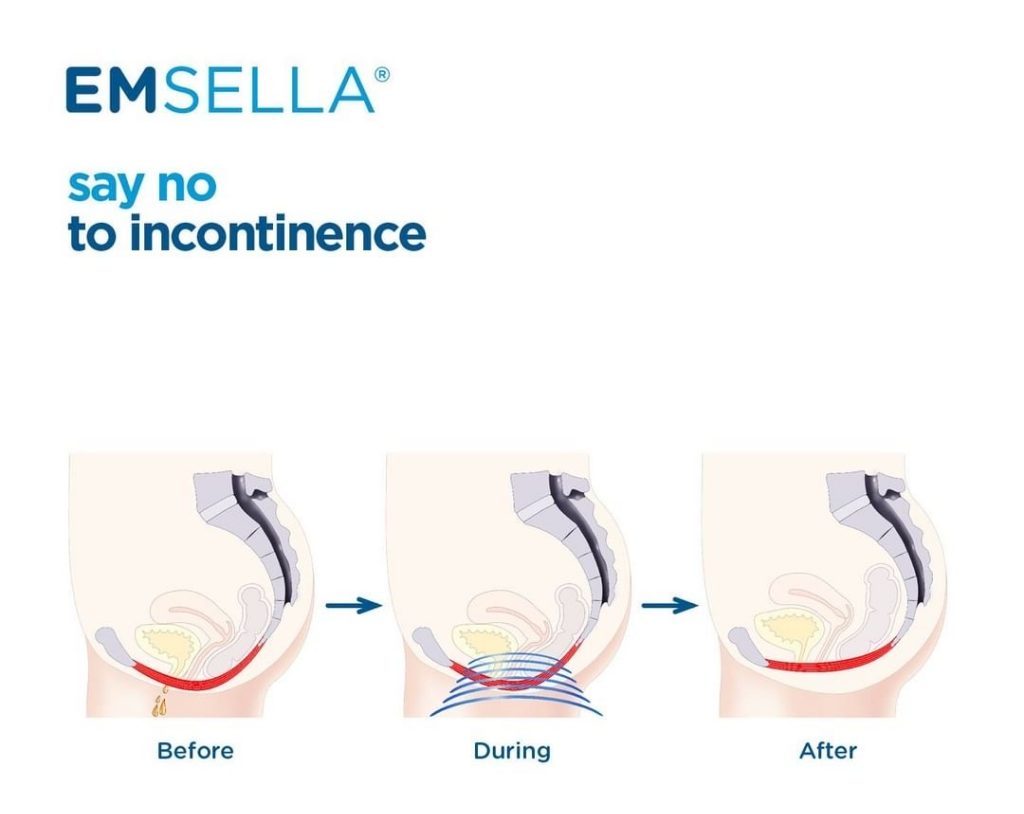 before and after emsella treatment