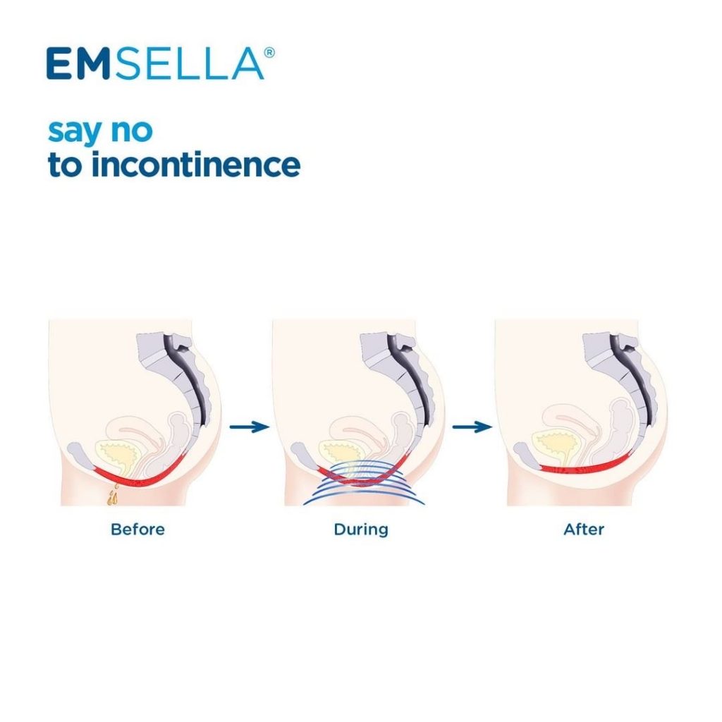 before and after emsella treatment