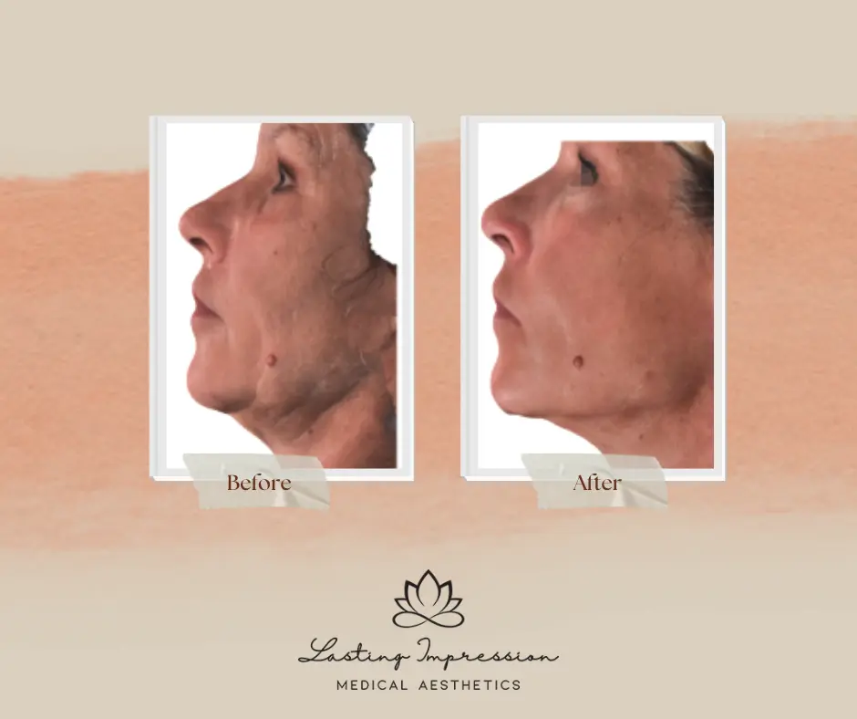 Fair Lawn Plasma Facial - Lasting Impression Med Spa