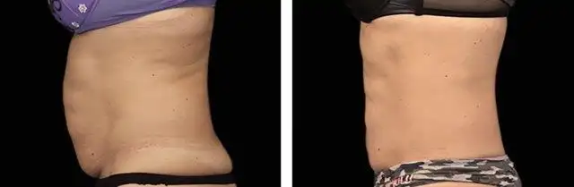 EMScuplt - Body Sculpting Treatment - Lasting Impression