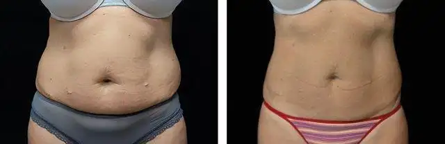 EMScuplt - Body Sculpting Treatment - Lasting Impression