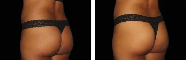 EMSculpt, Body Contouring Treatment