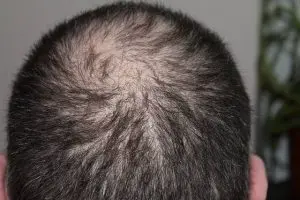 pepfactor-hair-loss-treatment-new-jersey-1-300x200