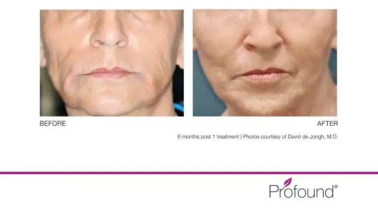 Patient 149342194, Profound RF Skin Tightening Before & After Photos