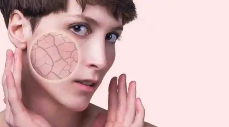 Dry Skin: Should you drink more water?