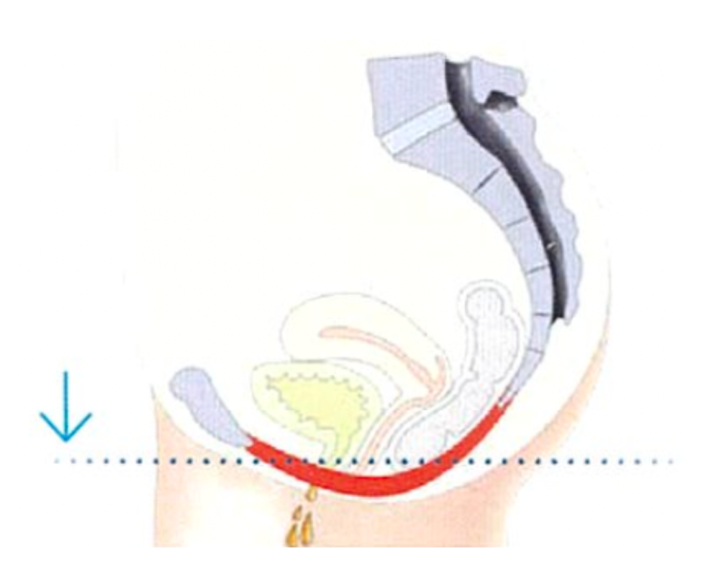 emsella before treatment