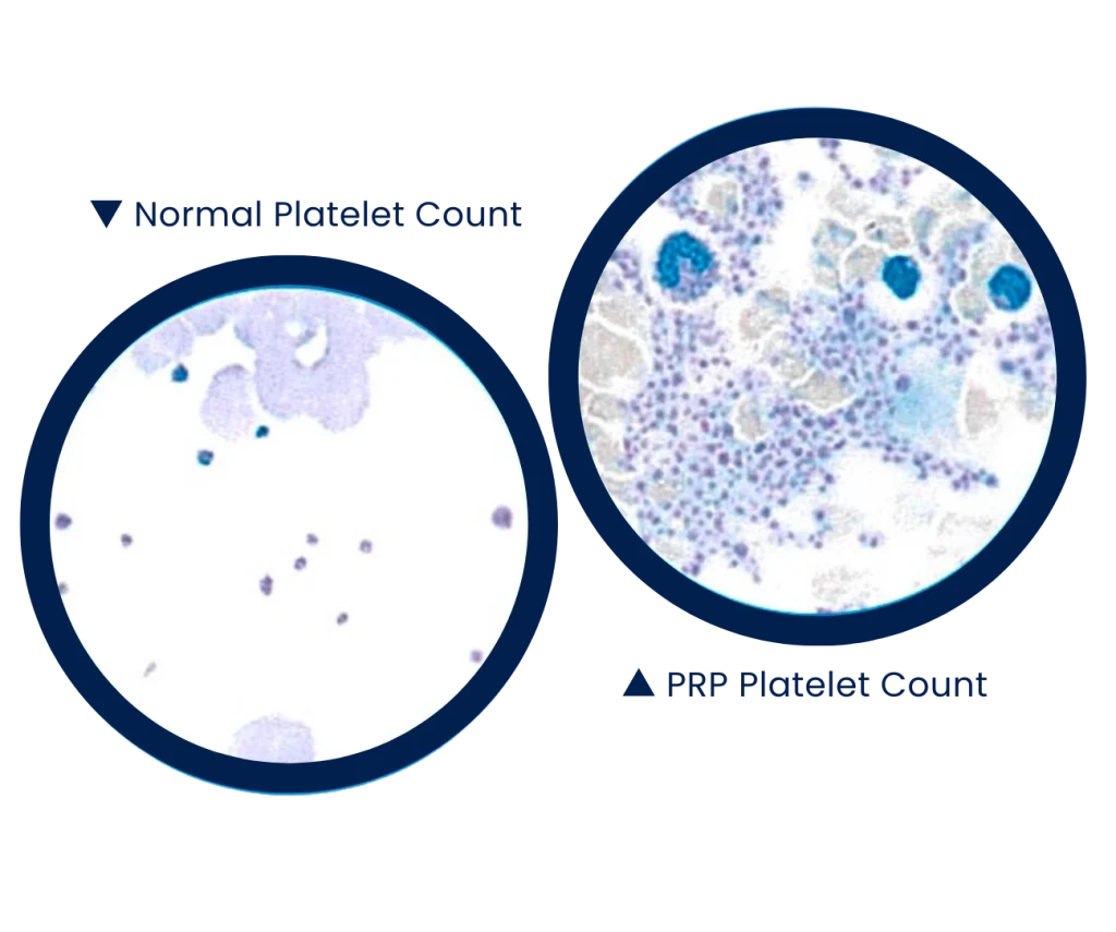 prp platelet count