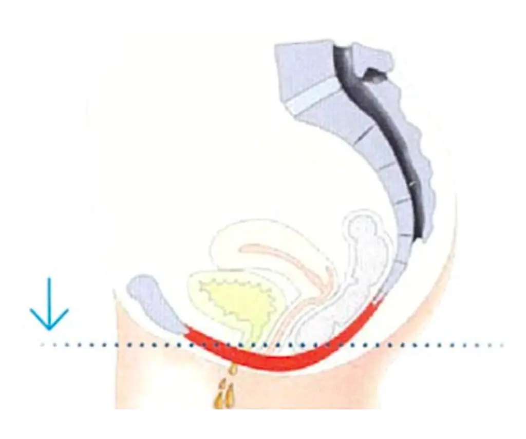 emsella before treatment