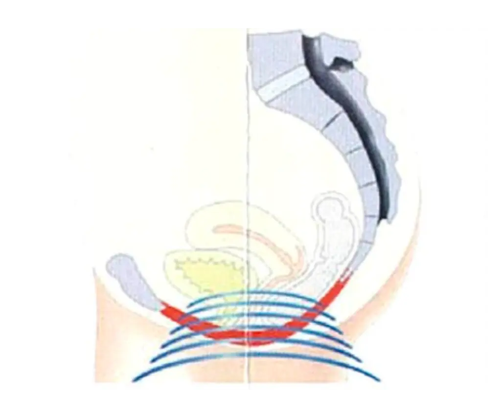 emsella during treatment