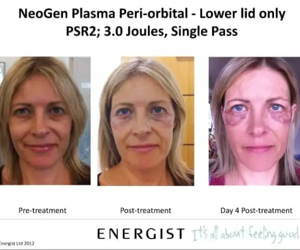 neogen-plasma-nj-fort-lee